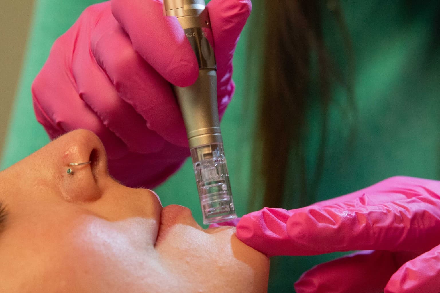 Precision microneedling device delivering collagen induction therapy