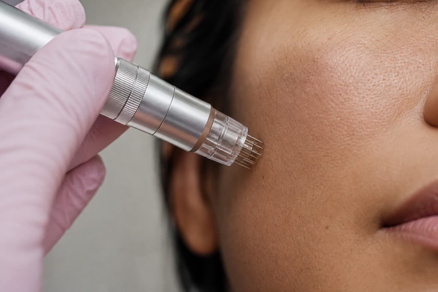 Precision microneedling device in use for natural-looking skin renewal