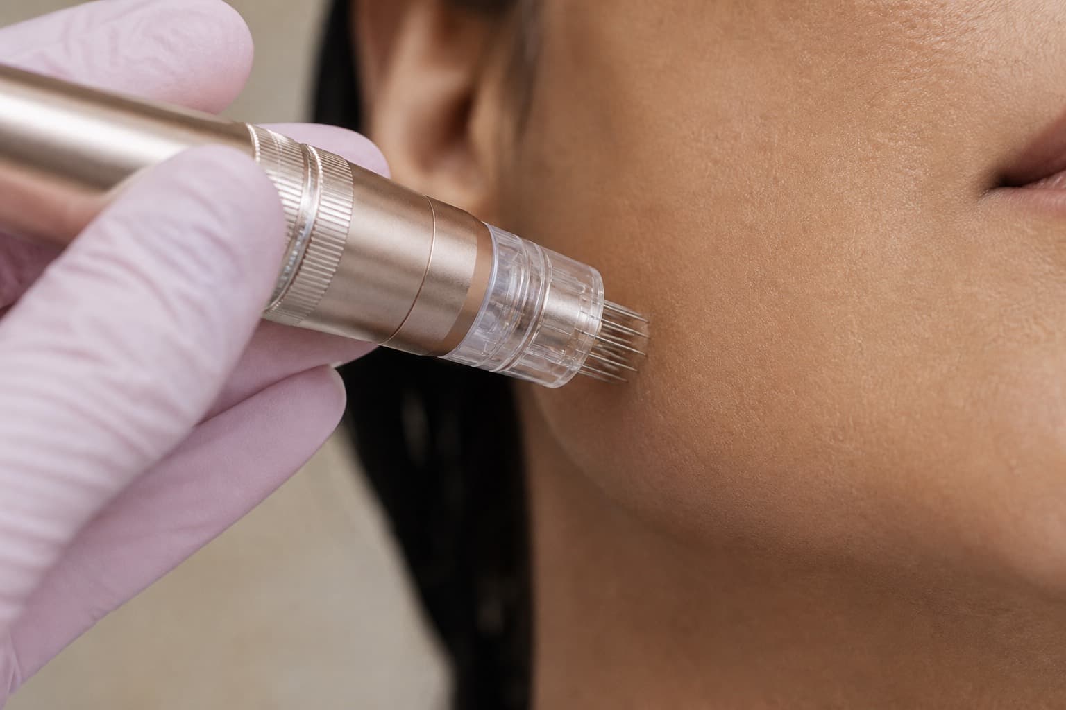 Microneedling along the jawline during Phase 2