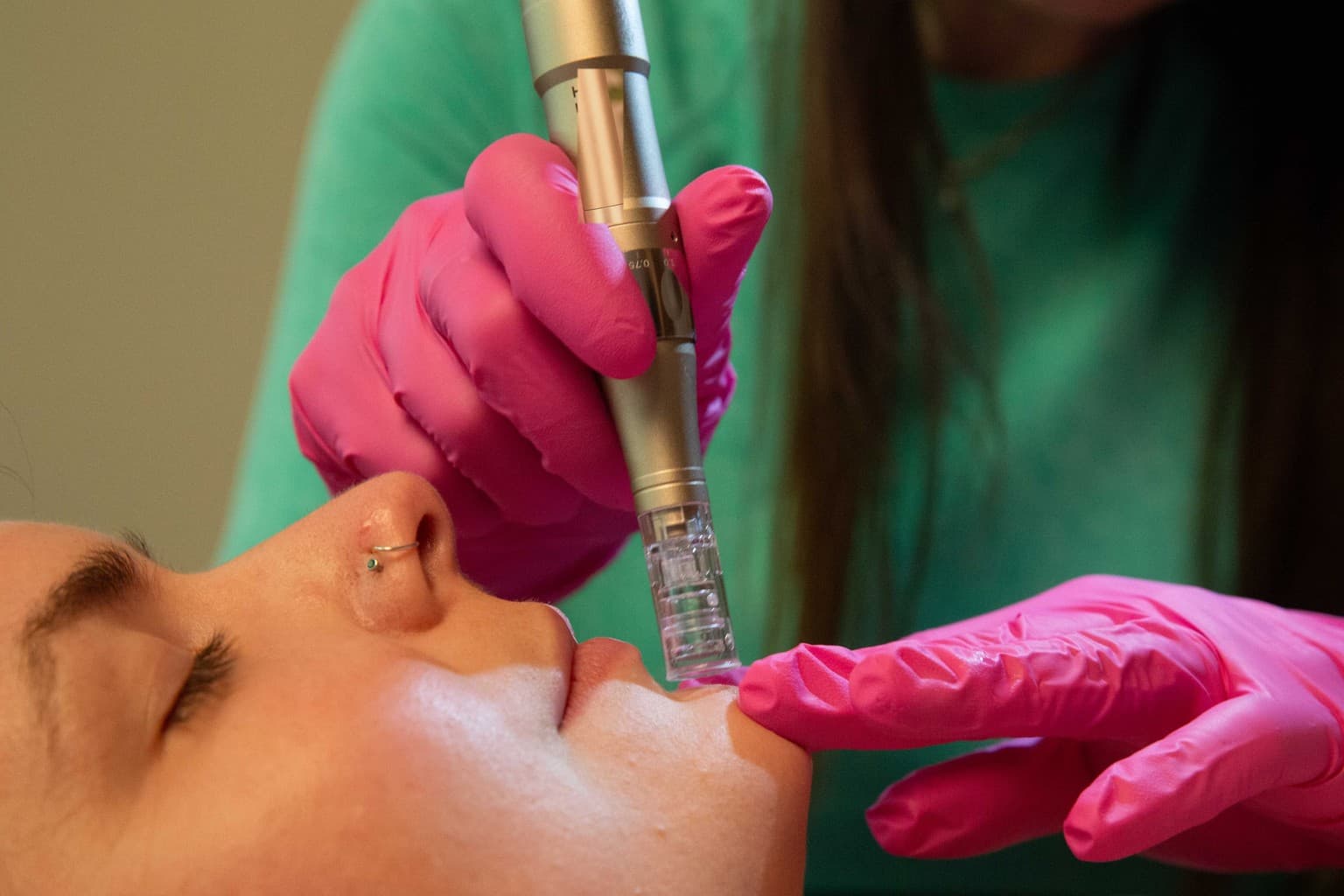 Federica Mingotti performing the microneedling test at 15-minute online consultation