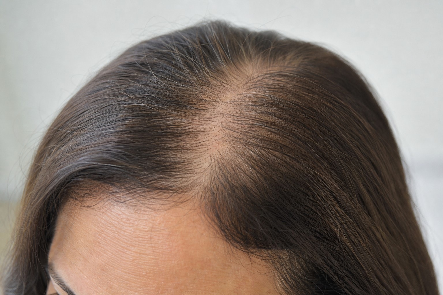 Scalp detail illustrating thinning relevant to Regrow · Scalp Vitality