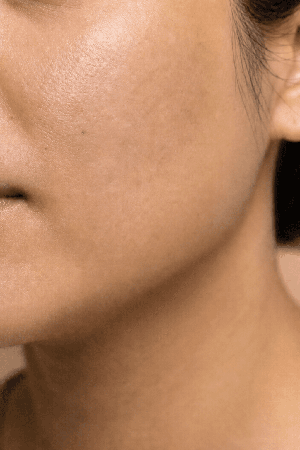 Illustrative after: cheek with softened scarring and more even tone