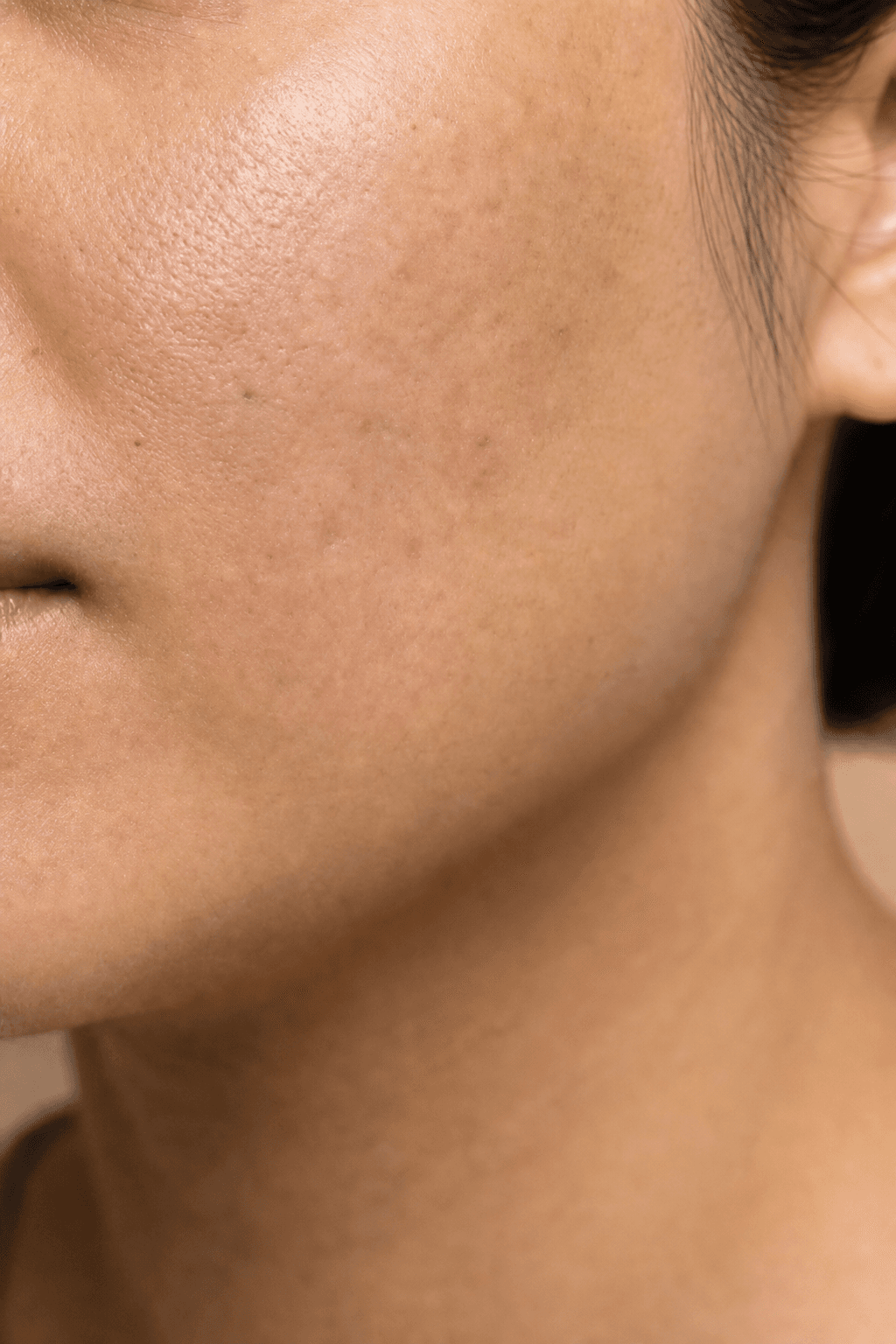 Illustrative before: cheek with atrophic acne scarring and uneven tone