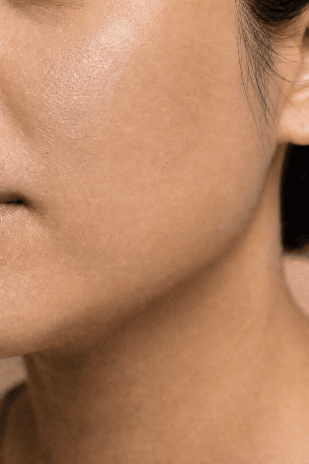 Illustrative after: cheek with smoother texture and faded scarring marks