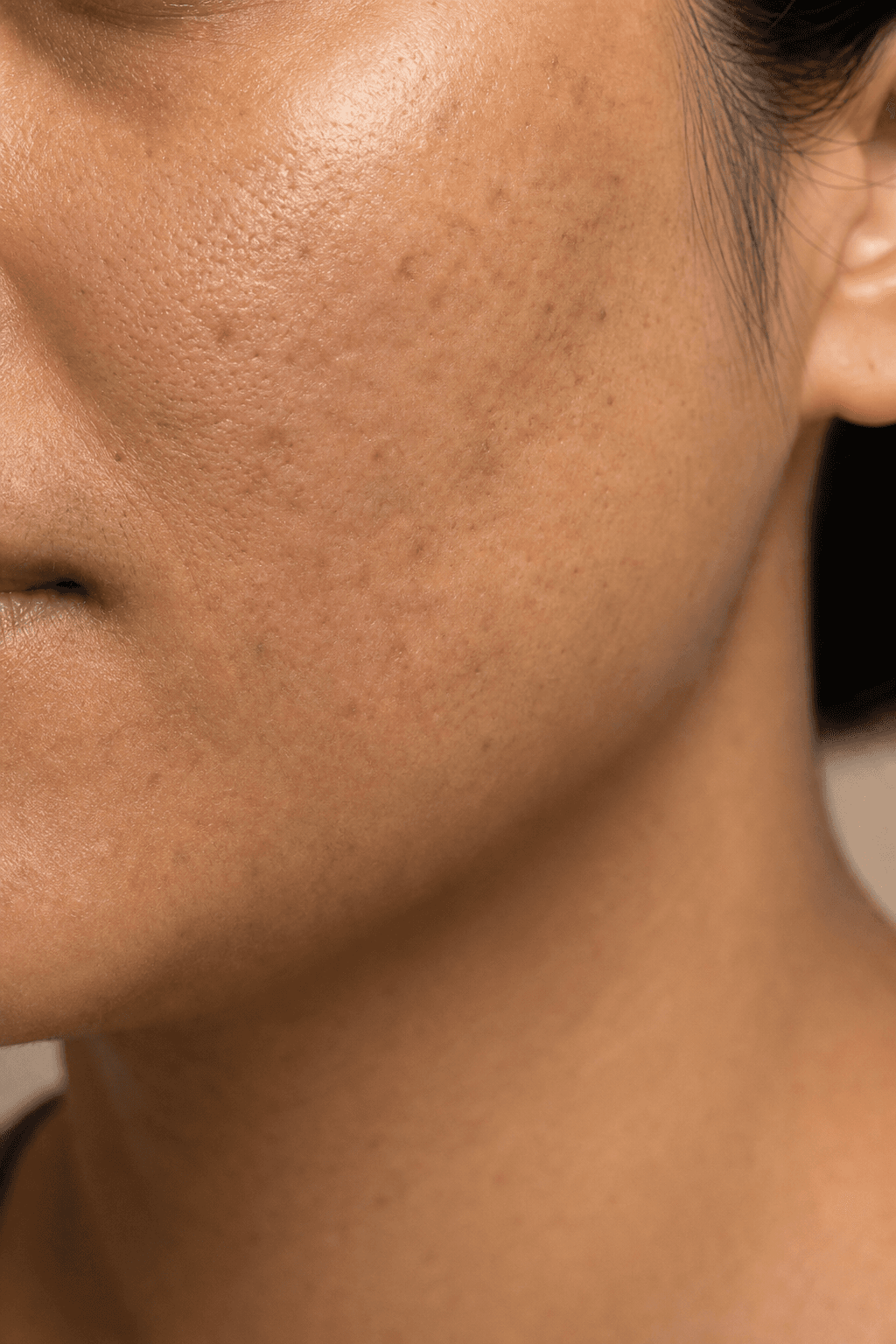 Close study of acne scarring relevant to Refine · Acne Scar Remodeling