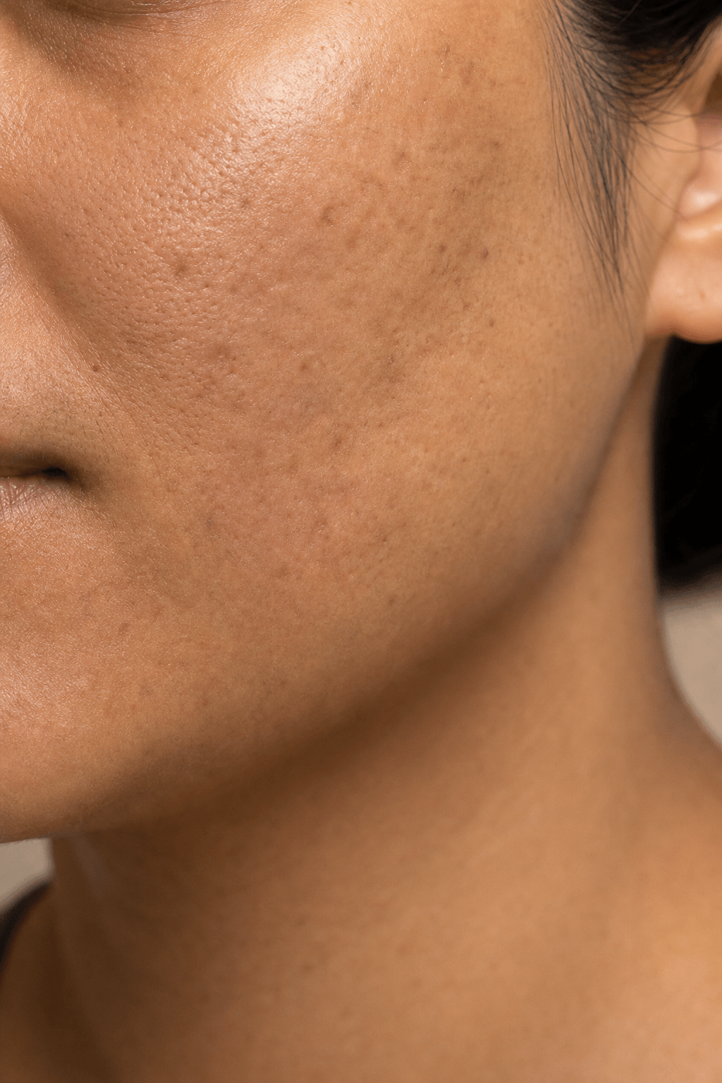 Close study of acne scarring relevant to Refine · Acne Scar Remodeling