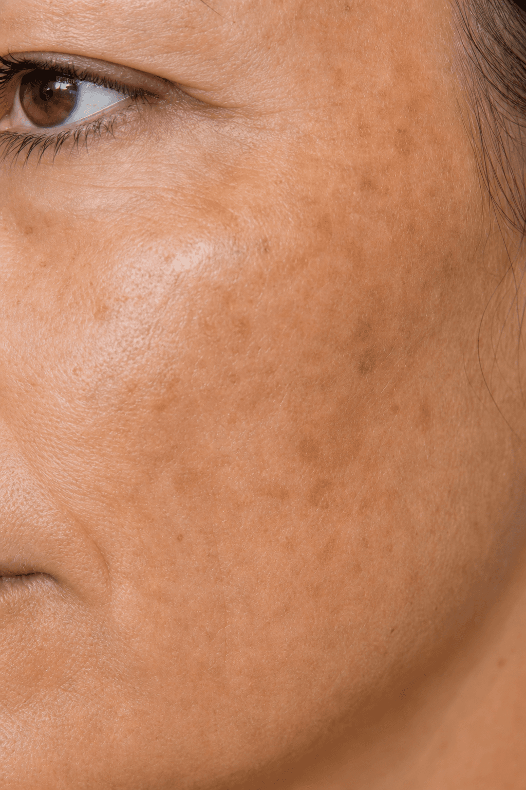Close study of sun damage and uneven tone relevant to Revive · Sun Damage + Pigmentation