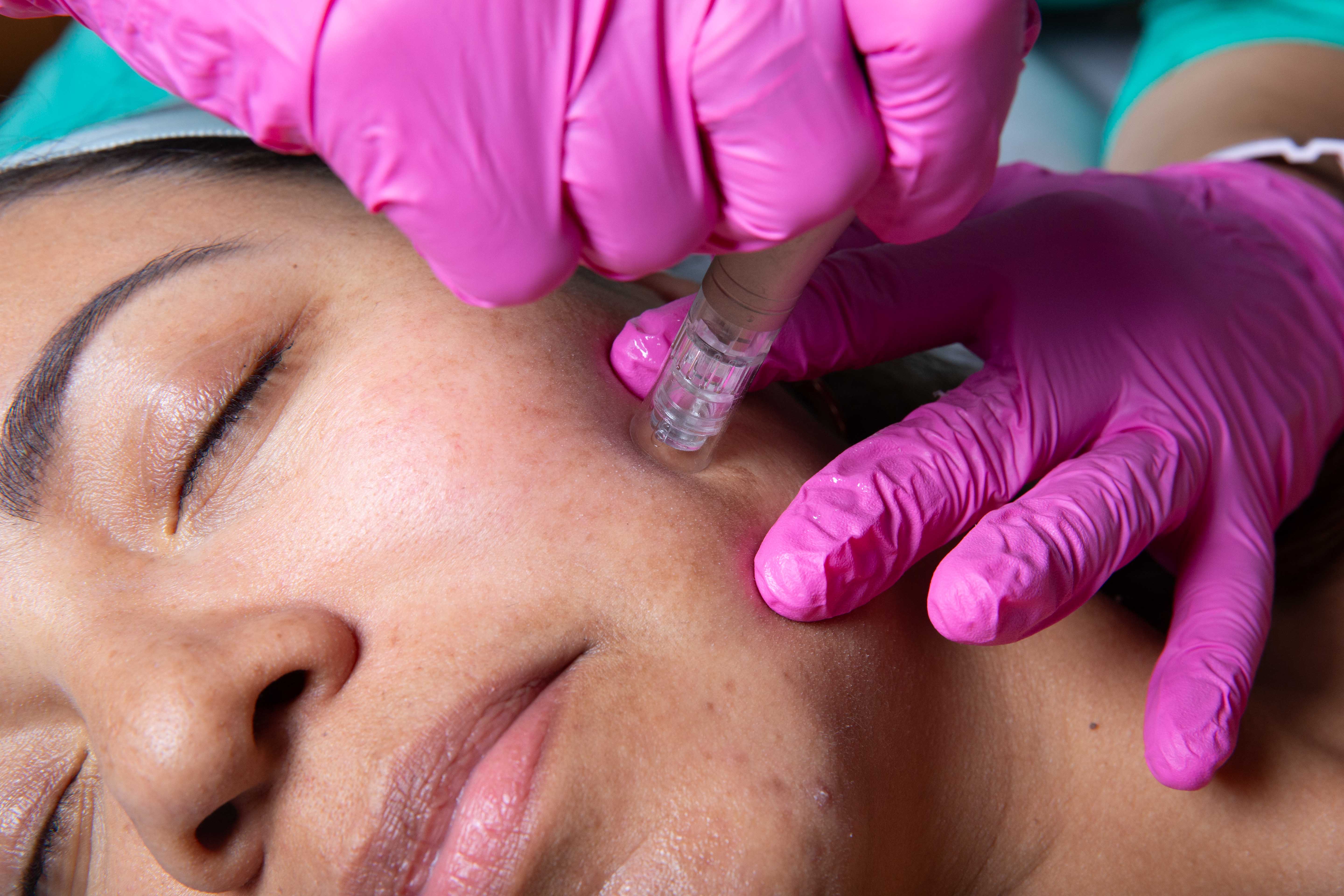 Hands providing facial massage during a microneedling care session