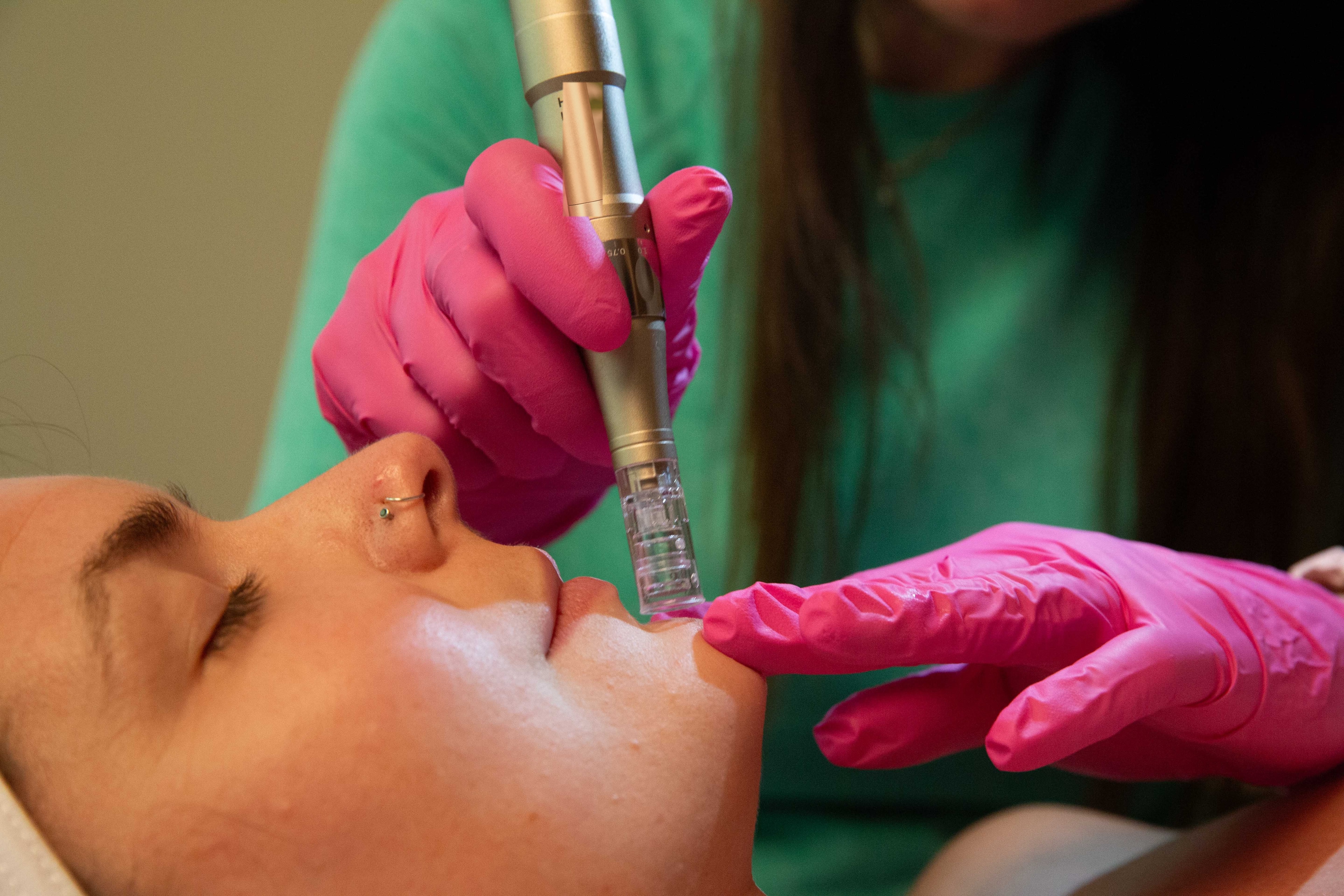 Precision device in use during microneedling care