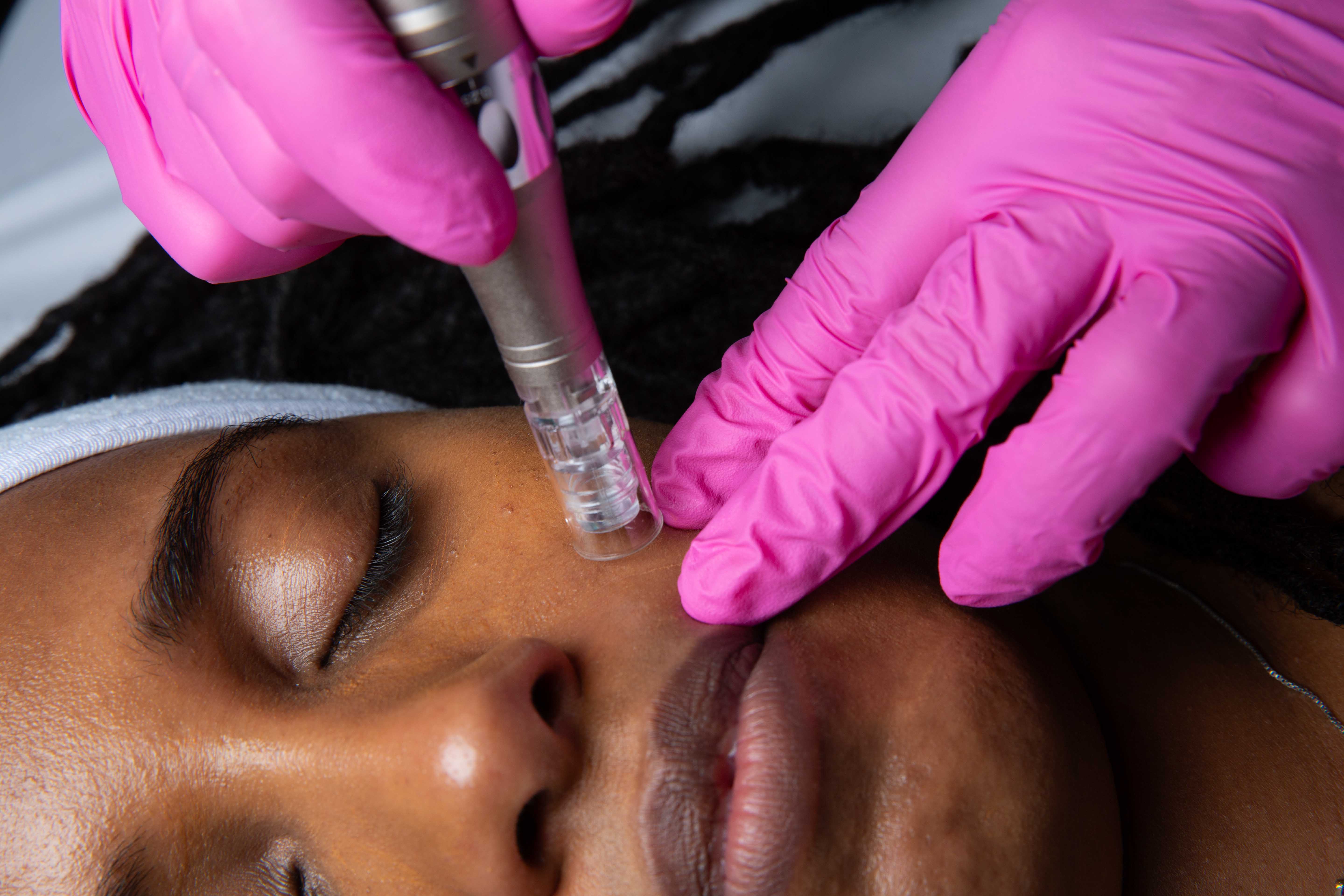 Microneedling care for deeper skin tones at The Regenerative Studio