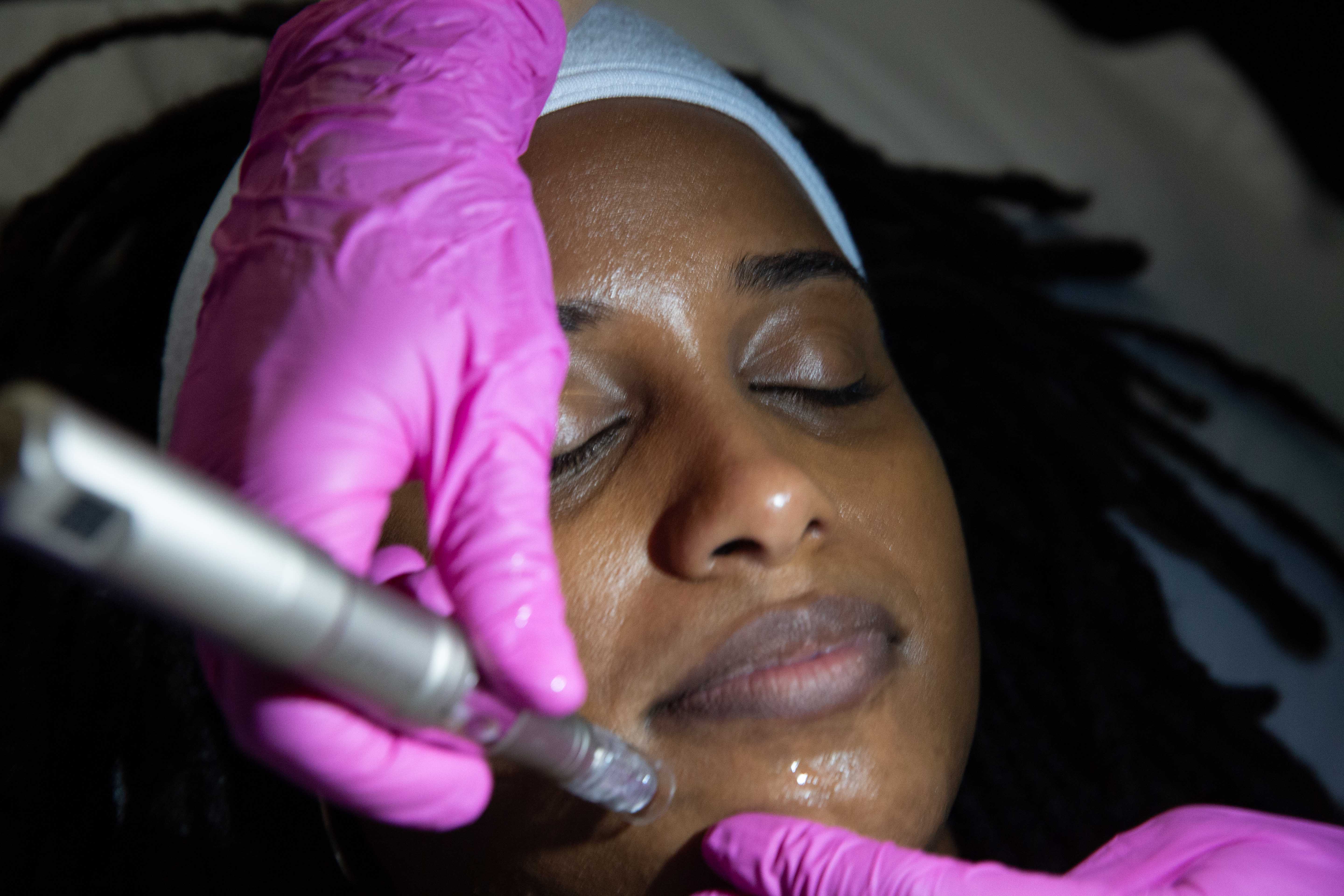 Acne scar revision microneedling in progress at The Regenerative Studio in Glen Allen